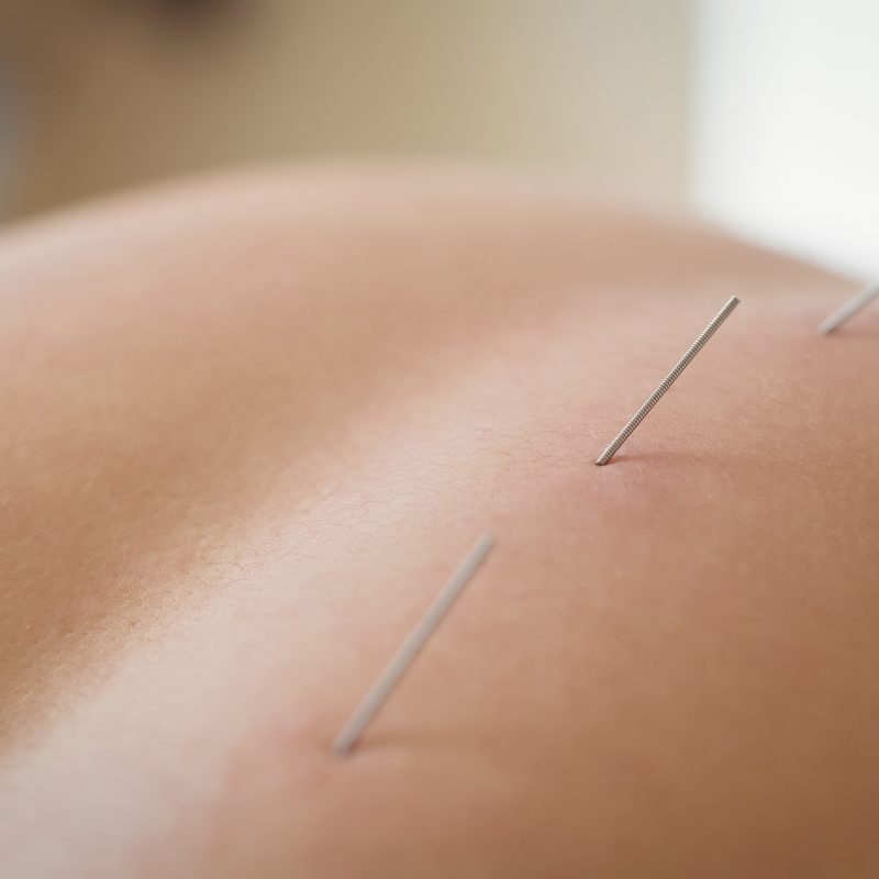 Close-up of a patient getting dry needling on his back